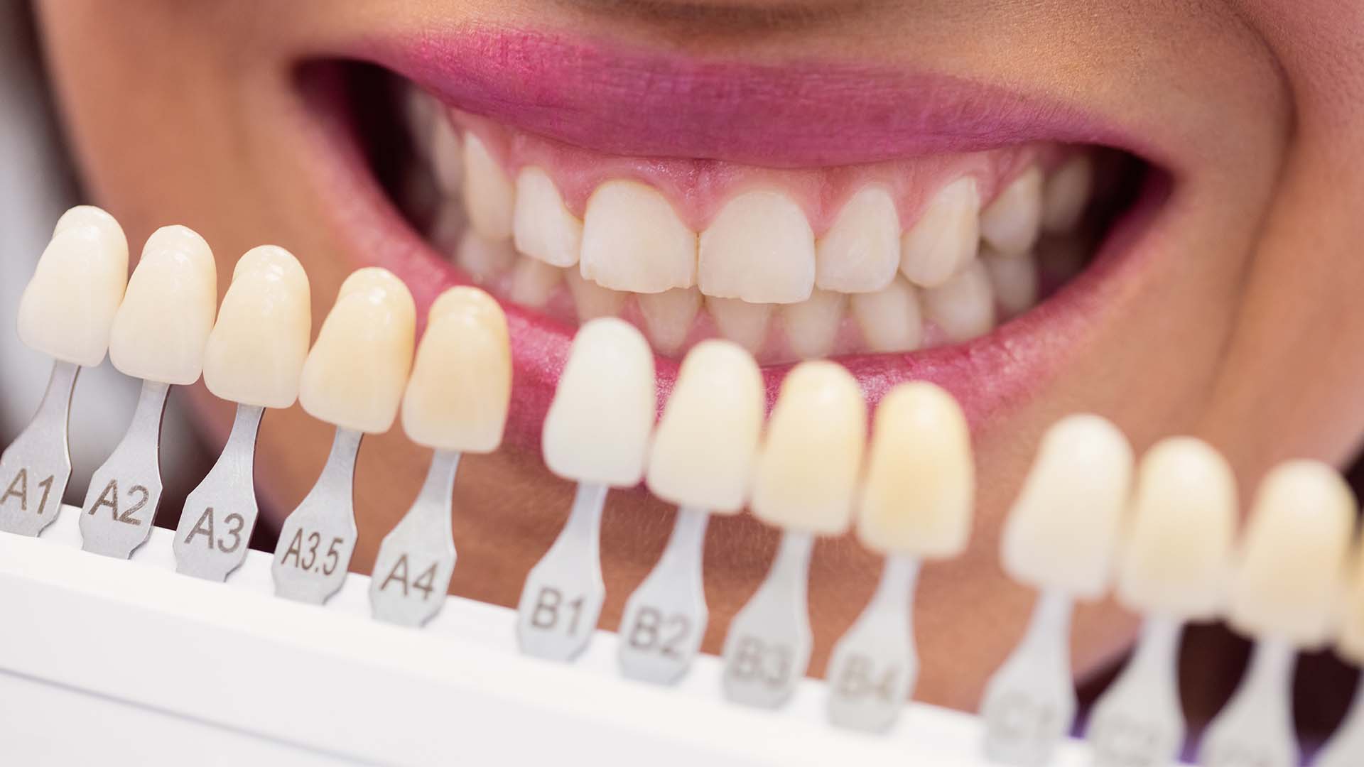 composite veneers