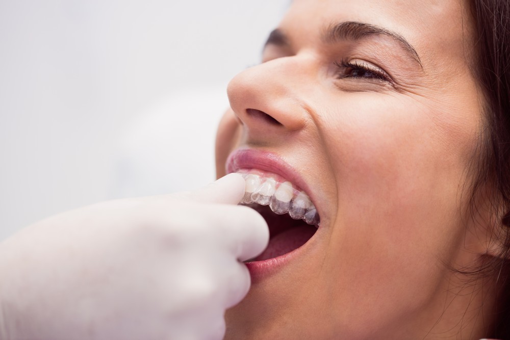 Steps for Obtaining Dental Braces