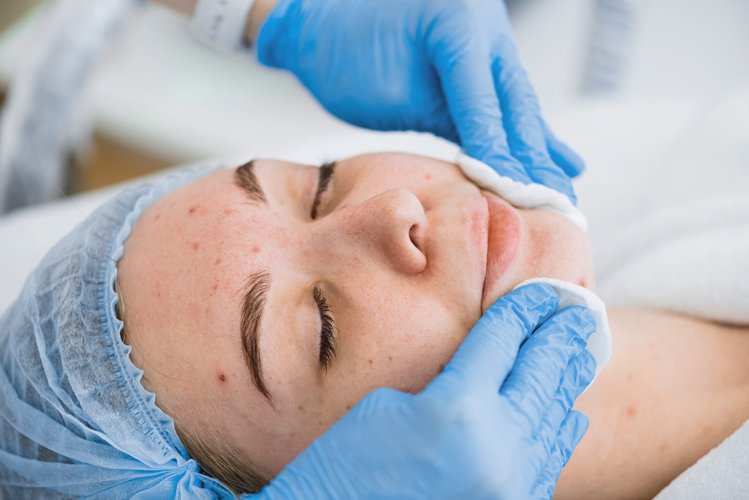 Sponge application of the mask on the face with problem skin.