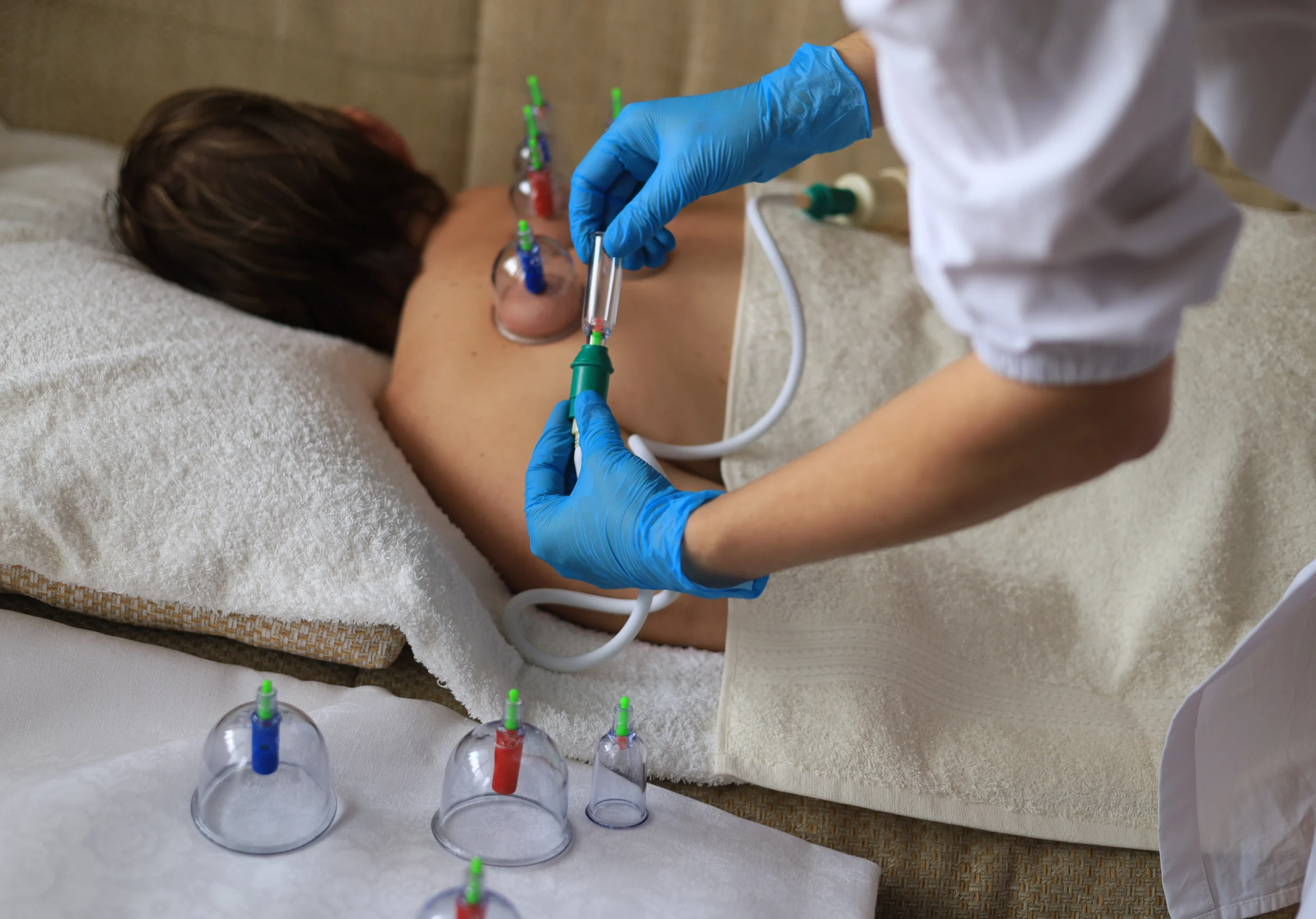 Best Hijama in Abu Dhabi at Purecare Medical Center – medical Hijama therapy session